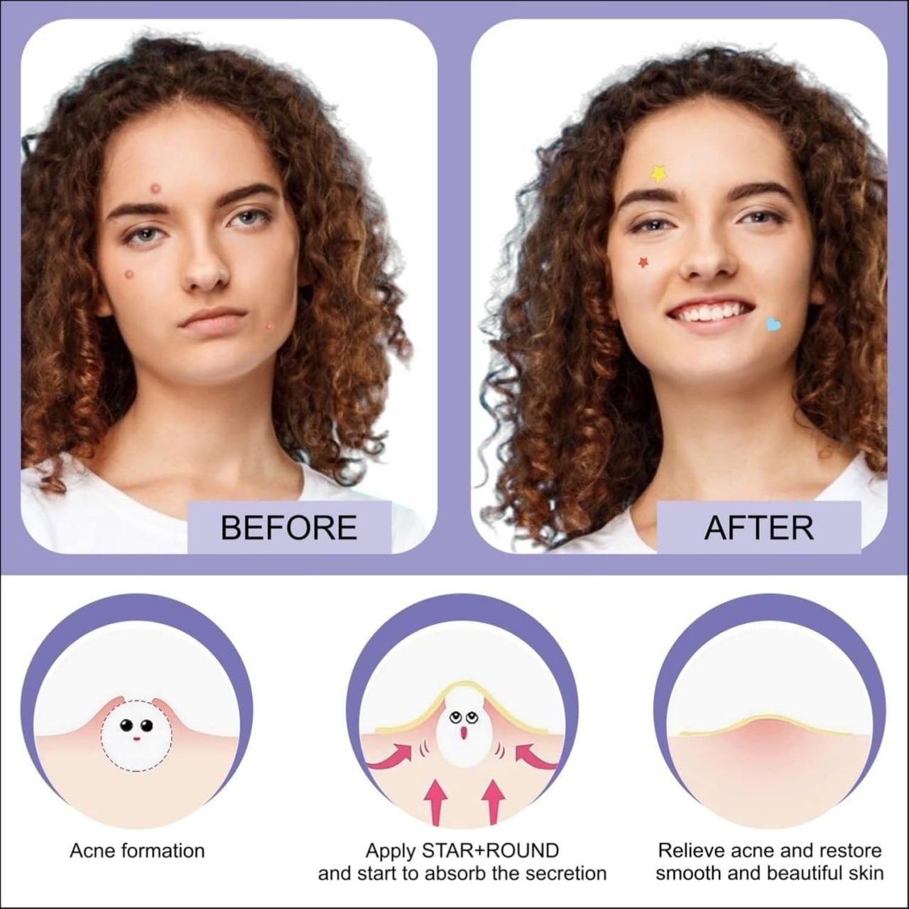 30 Pcs Pimple Patches